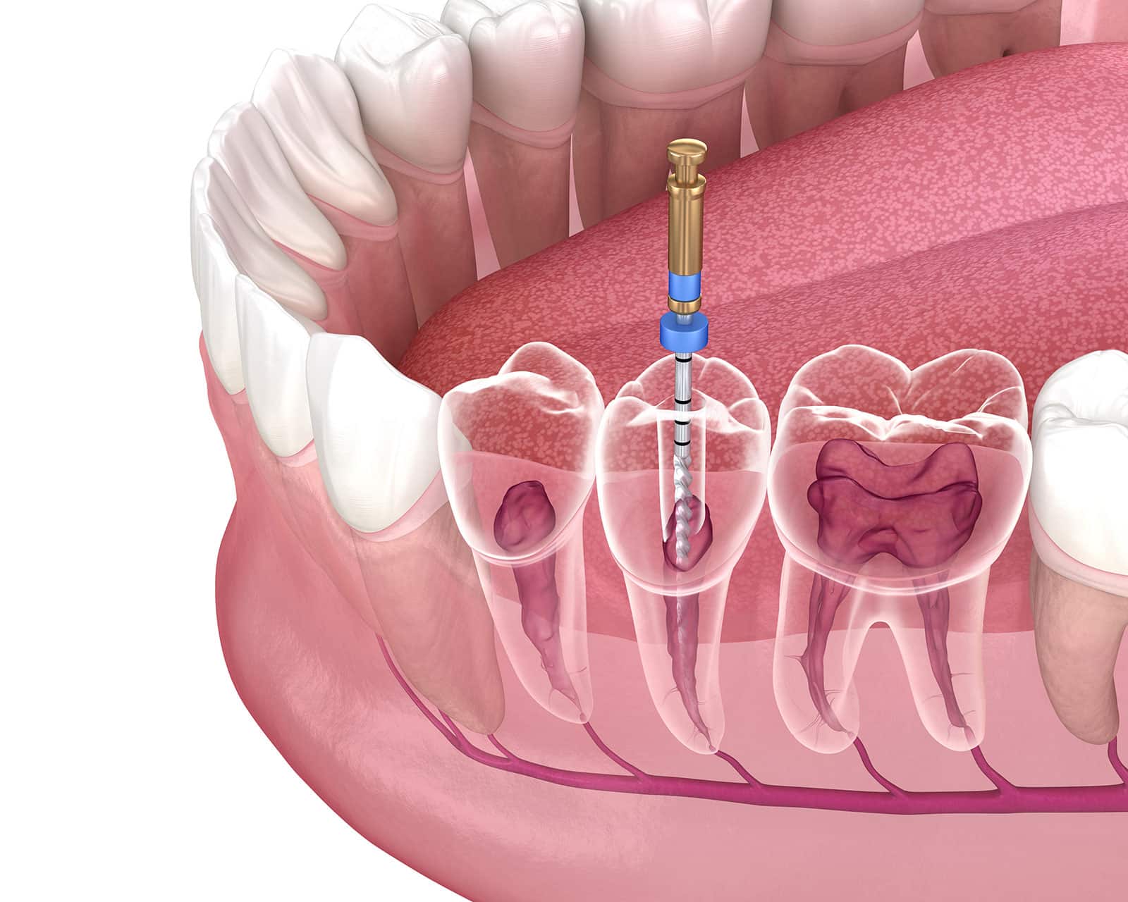 Root canal