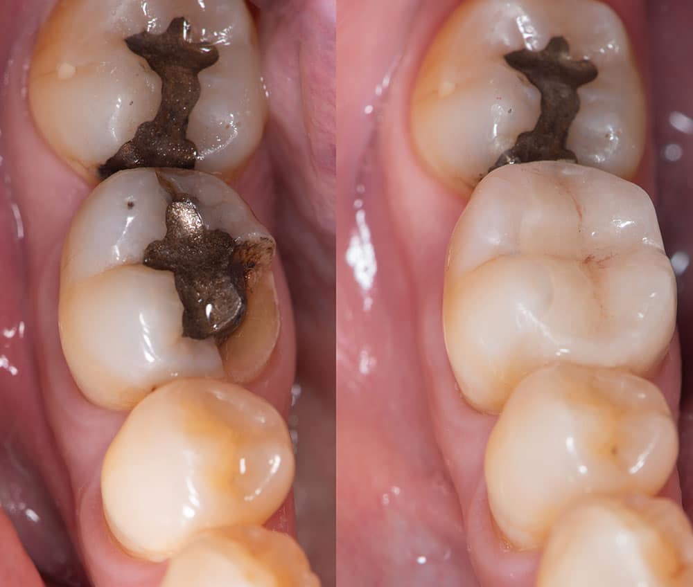 Mercury dental amalgam fillings are safe for most people