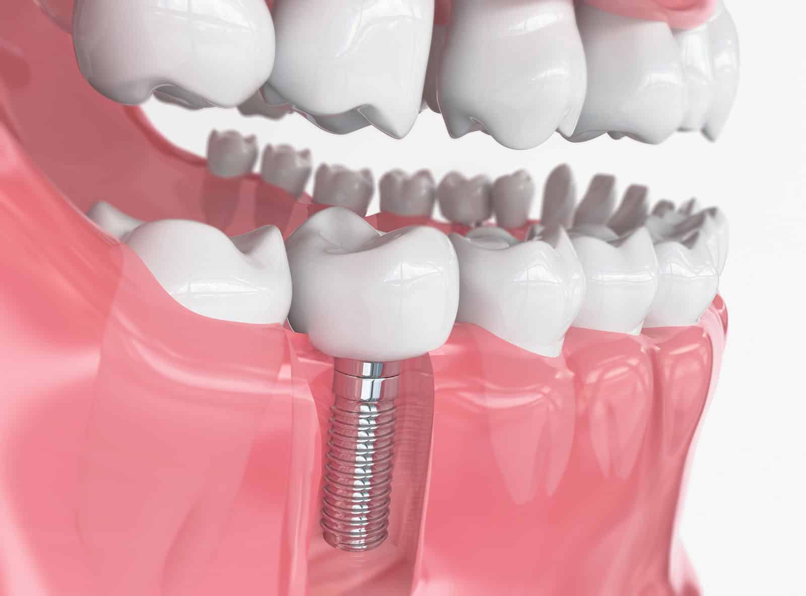 Am I a Candidate for Dental Implants