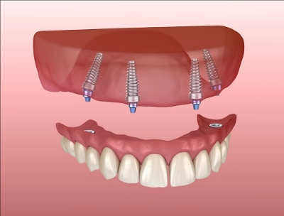 Maxillary and Mandibular prosthesis with gum All on 4 system supported by implants. Medically accurate 3D illustration of human teeth and dentures