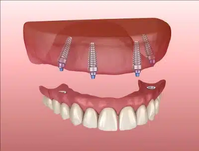 Maxillary and Mandibular prosthesis with gum All on 4 system supported by implants. Medically accurate 3D illustration of human teeth and dentures