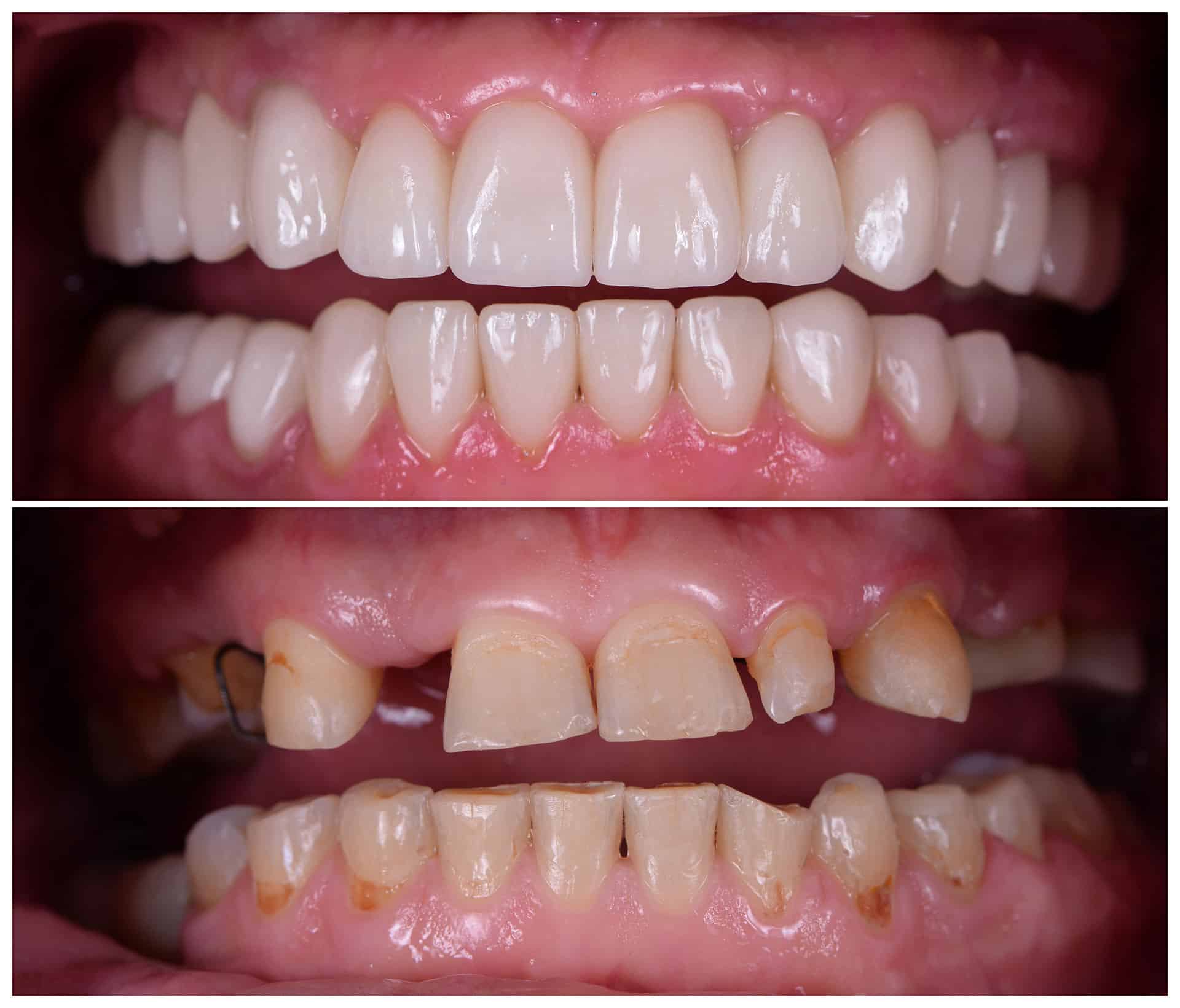 Porcelain Veneers