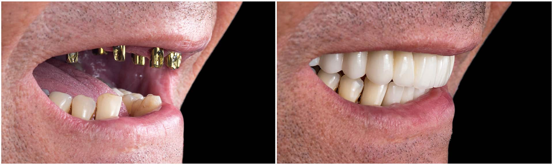 Patient Smiling with Dental Implants at Elite Simi Valley Dentists