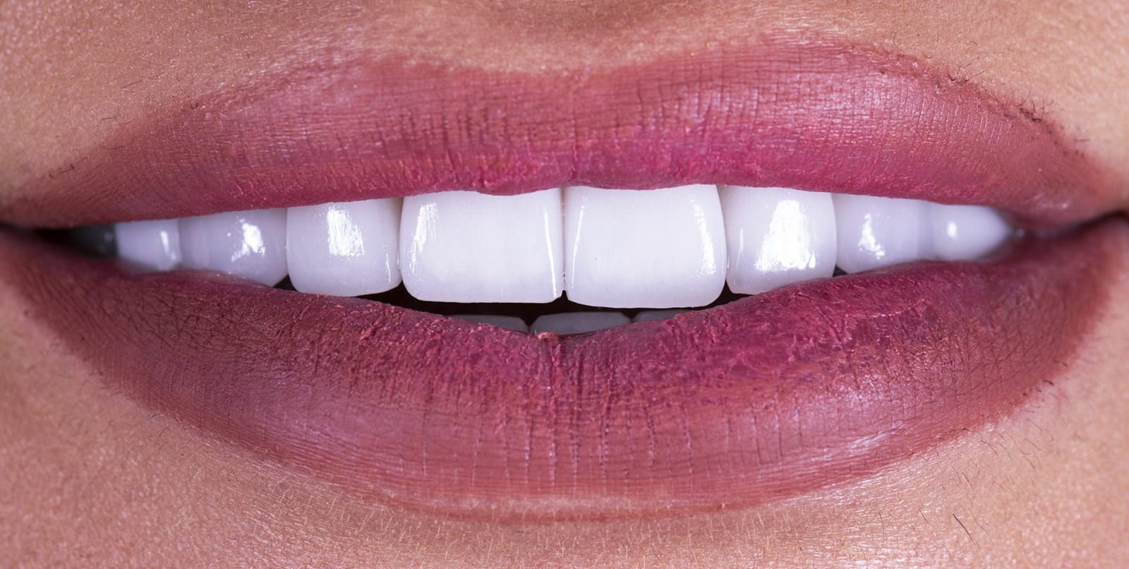 porcelain-veneers