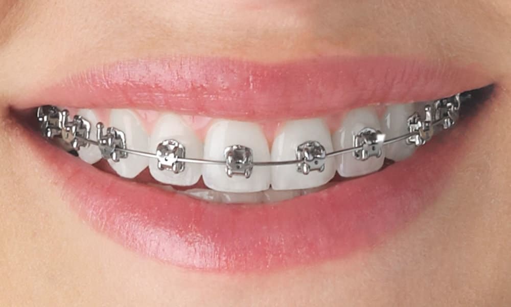 Orthodontic Treatments